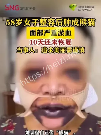 58岁女子整容翻车